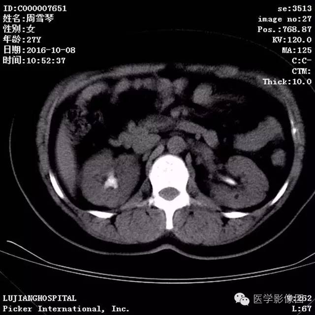 【病例】结节硬化症1例CT及MR影像表现 【病例】结节硬化症1例CT及MR影像表现