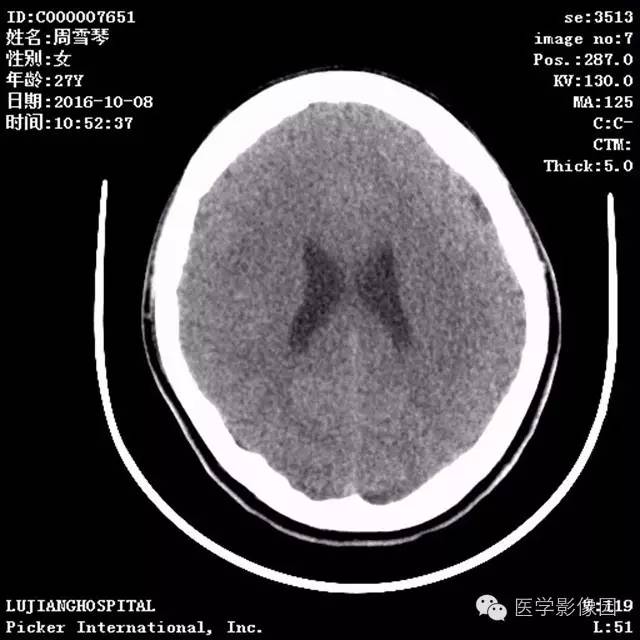 【病例】结节硬化症1例CT及MR影像表现 【病例】结节硬化症1例CT及MR影像表现