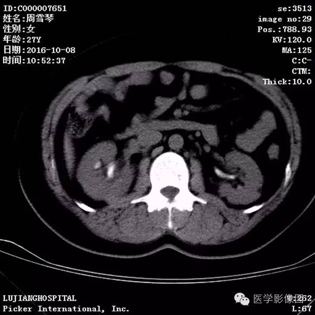 【病例】结节硬化症1例CT及MR影像表现 【病例】结节硬化症1例CT及MR影像表现
