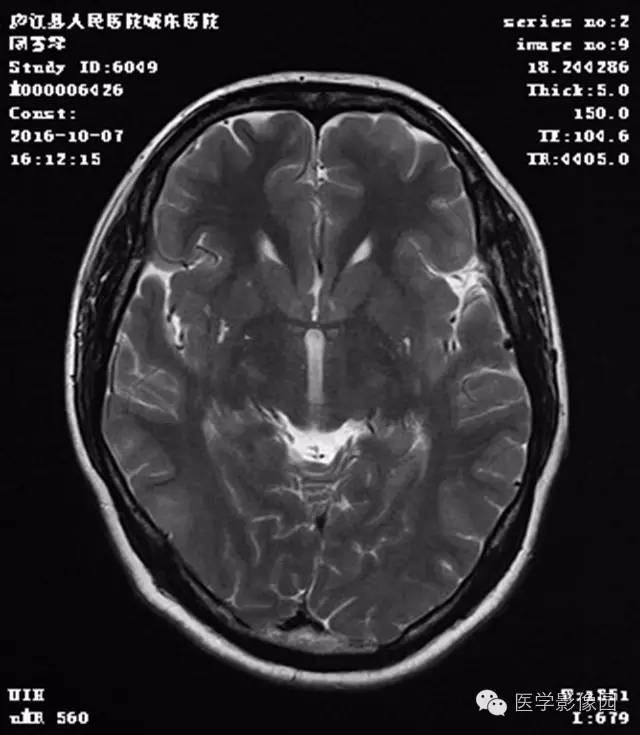 【病例】结节硬化症1例CT及MR影像表现 【病例】结节硬化症1例CT及MR影像表现