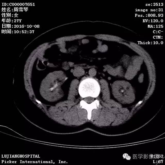 【病例】结节硬化症1例CT及MR影像表现 【病例】结节硬化症1例CT及MR影像表现