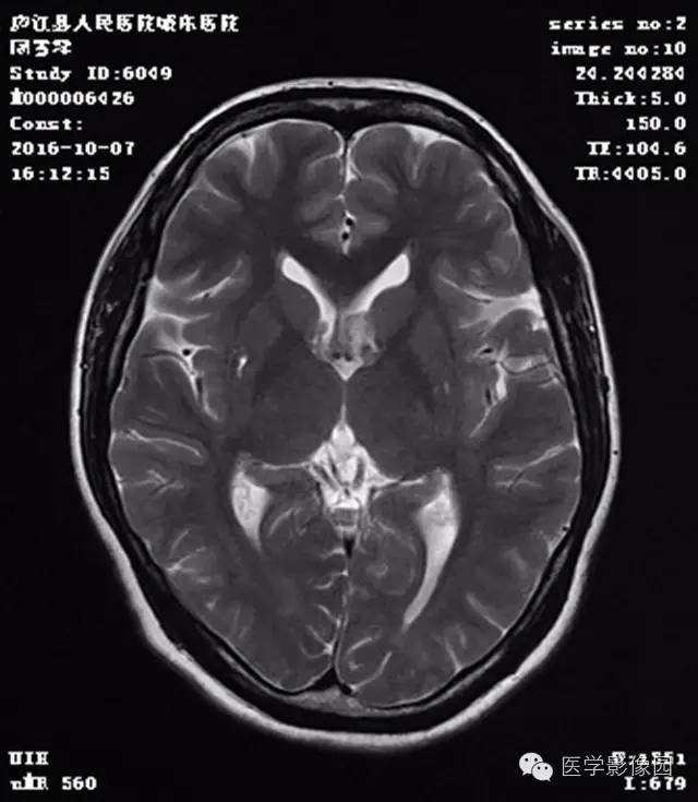 【病例】结节硬化症1例CT及MR影像表现 【病例】结节硬化症1例CT及MR影像表现