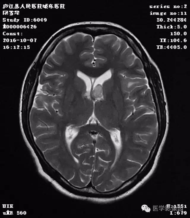 【病例】结节硬化症1例CT及MR影像表现 【病例】结节硬化症1例CT及MR影像表现