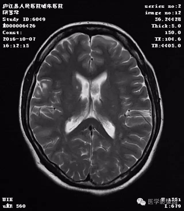 【病例】结节硬化症1例CT及MR影像表现 【病例】结节硬化症1例CT及MR影像表现