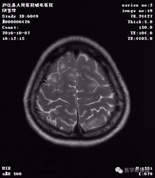 【病例】结节硬化症1例CT及MR影像表现 【病例】结节硬化症1例CT及MR影像表现