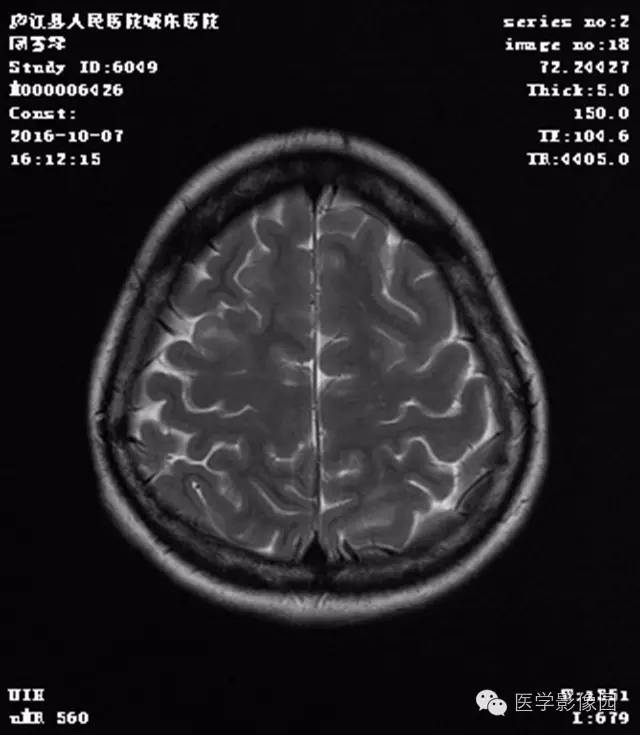 【病例】结节硬化症1例CT及MR影像表现 【病例】结节硬化症1例CT及MR影像表现