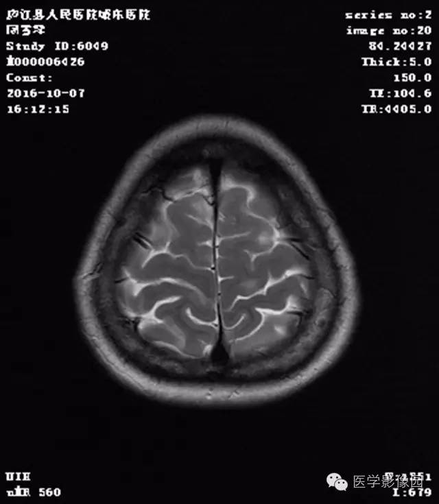 【病例】结节硬化症1例CT及MR影像表现 【病例】结节硬化症1例CT及MR影像表现
