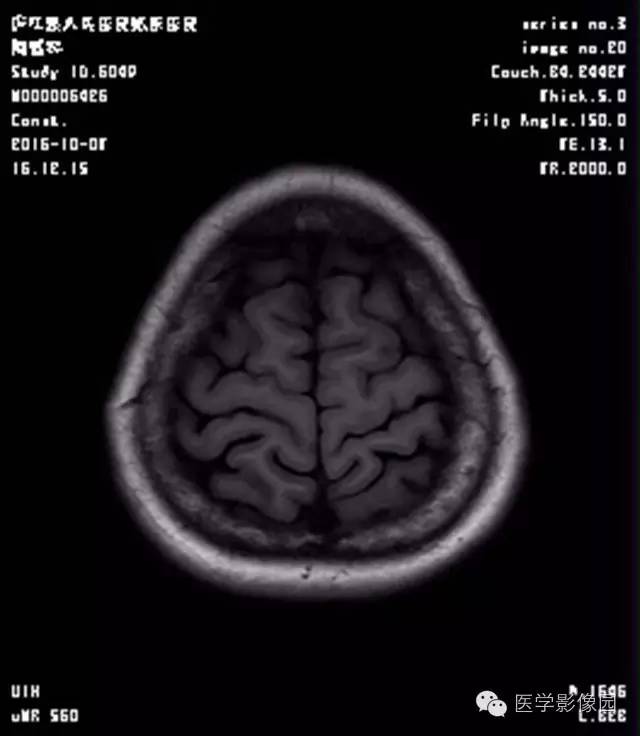 【病例】结节硬化症1例CT及MR影像表现 【病例】结节硬化症1例CT及MR影像表现