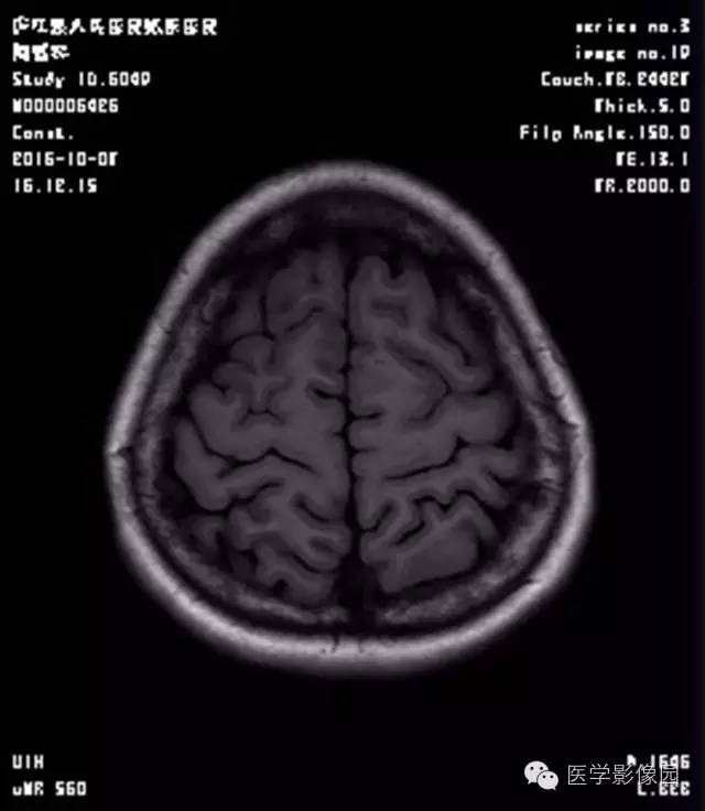 【病例】结节硬化症1例CT及MR影像表现 【病例】结节硬化症1例CT及MR影像表现