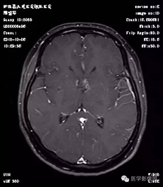 【病例】结节硬化症1例CT及MR影像表现 【病例】结节硬化症1例CT及MR影像表现