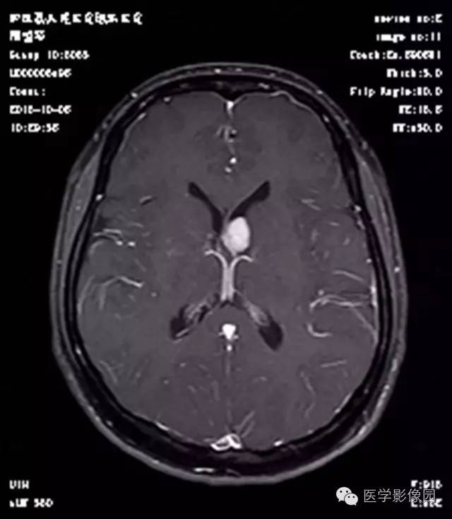 【病例】结节硬化症1例CT及MR影像表现 【病例】结节硬化症1例CT及MR影像表现