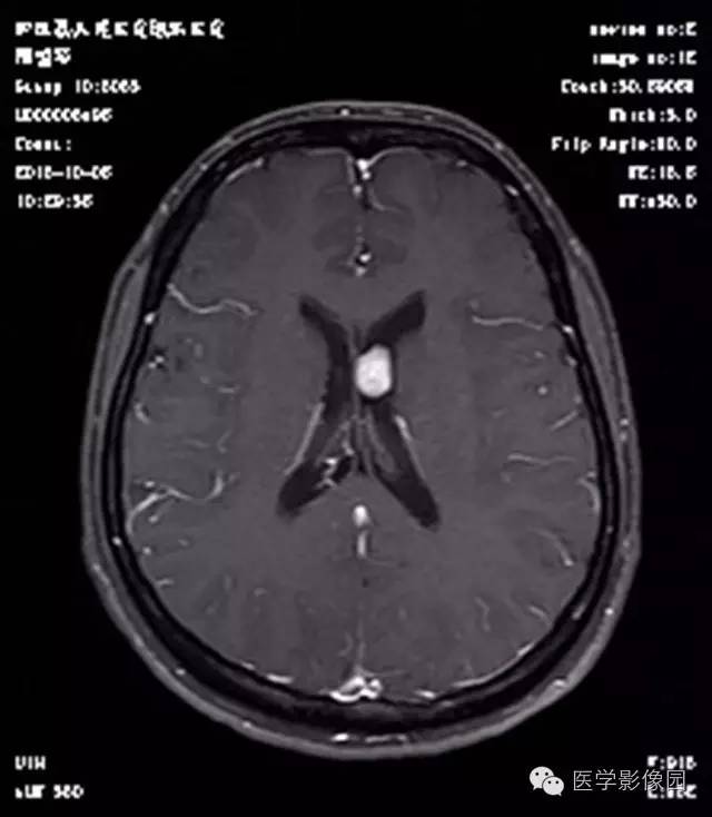 【病例】结节硬化症1例CT及MR影像表现 【病例】结节硬化症1例CT及MR影像表现