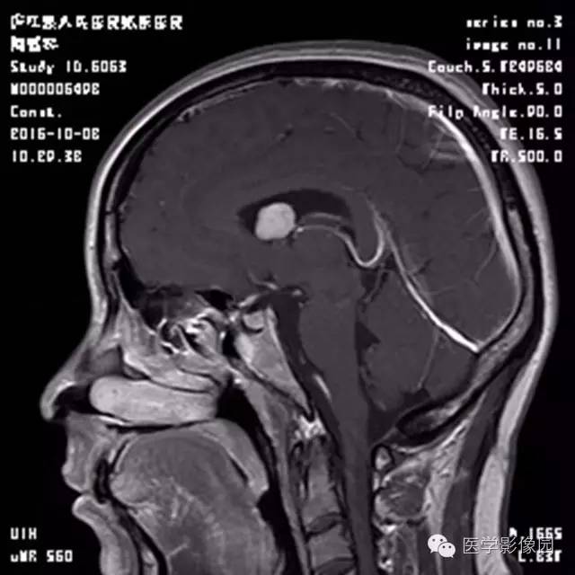 【病例】结节硬化症1例CT及MR影像表现 【病例】结节硬化症1例CT及MR影像表现