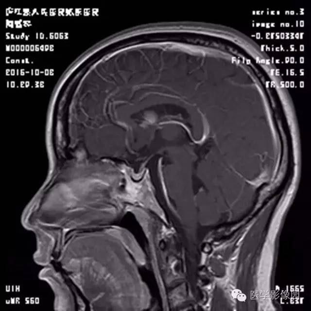 【病例】结节硬化症1例CT及MR影像表现 【病例】结节硬化症1例CT及MR影像表现