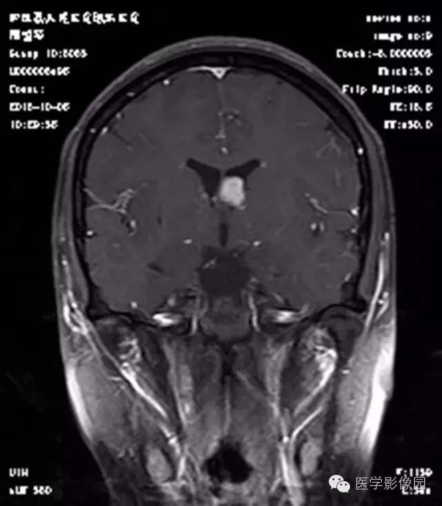 【病例】结节硬化症1例CT及MR影像表现 【病例】结节硬化症1例CT及MR影像表现