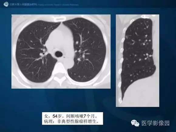 【PPT】肺部GGO的影像与病理