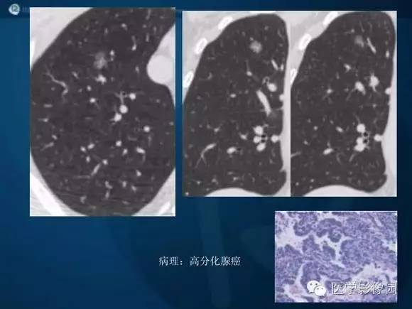 【PPT】肺部GGO的影像与病理