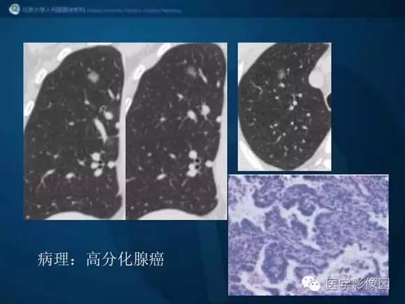【PPT】肺部GGO的影像与病理