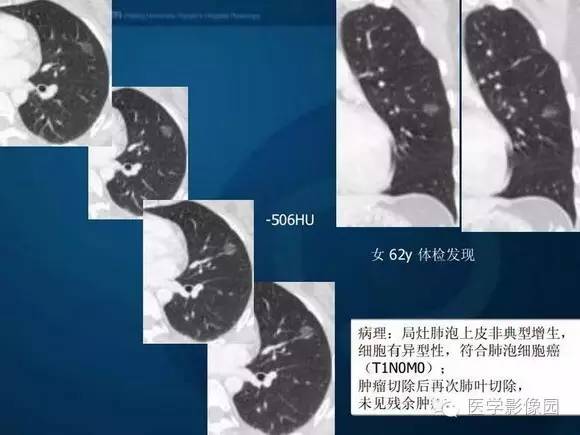 【PPT】肺部GGO的影像与病理