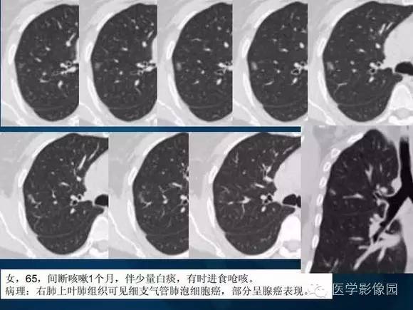 【PPT】肺部GGO的影像与病理