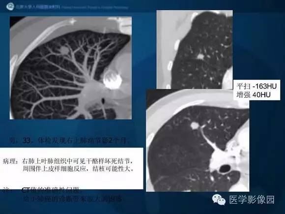 【PPT】肺部GGO的影像与病理
