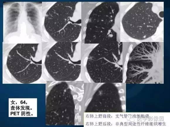 【PPT】肺部GGO的影像与病理