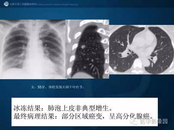 【PPT】肺部GGO的影像与病理