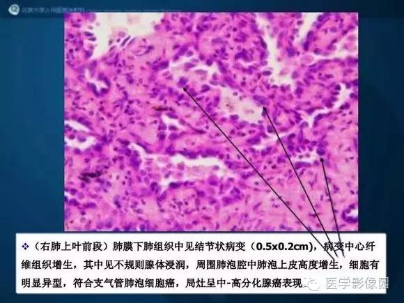 【PPT】肺部GGO的影像与病理