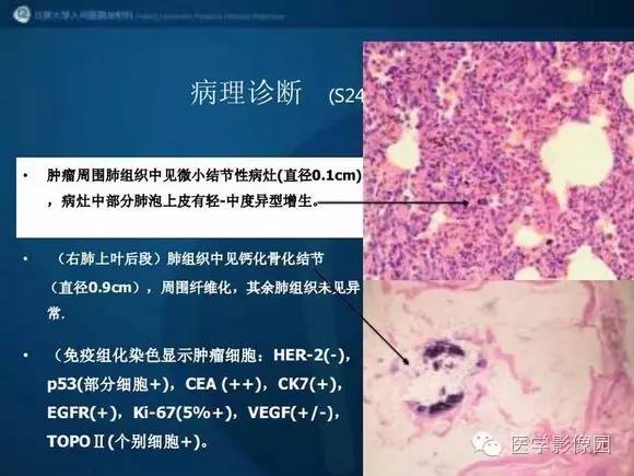 【PPT】肺部GGO的影像与病理