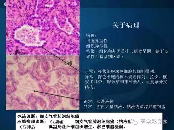 【PPT】肺部GGO的影像与病理