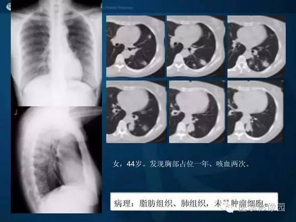 【PPT】肺部GGO的影像与病理