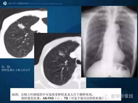 【PPT】肺部GGO的影像与病理