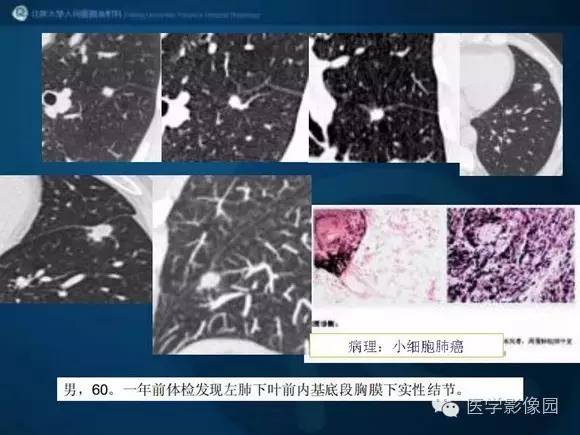 【PPT】肺部GGO的影像与病理