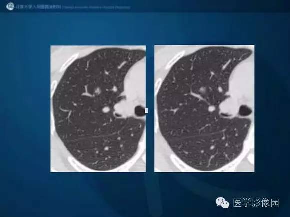 【PPT】肺部GGO的影像与病理