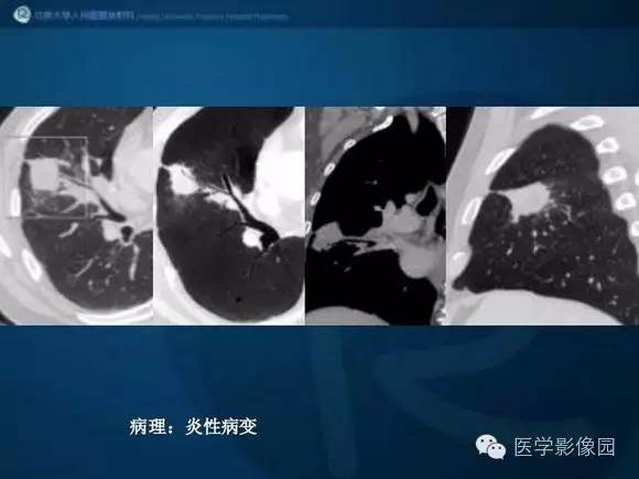 【PPT】肺部GGO的影像与病理