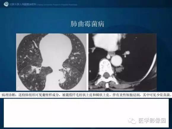 【PPT】肺部GGO的影像与病理
