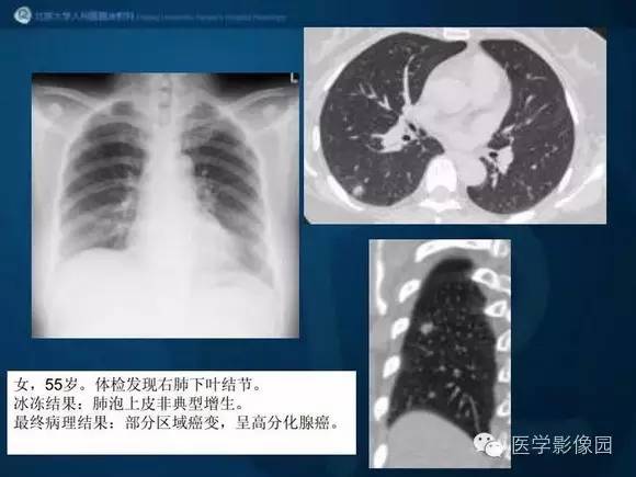 【PPT】肺部GGO的影像与病理