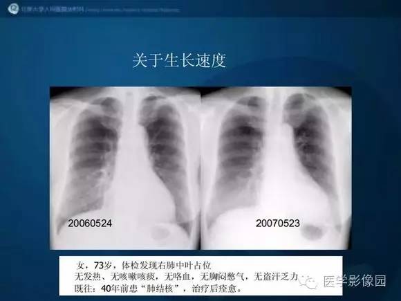 【PPT】肺部GGO的影像与病理