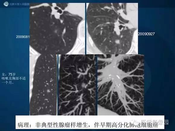 【PPT】肺部GGO的影像与病理