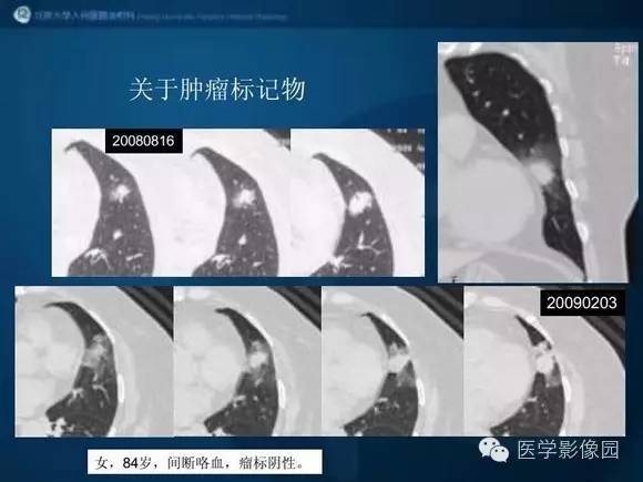 【PPT】肺部GGO的影像与病理