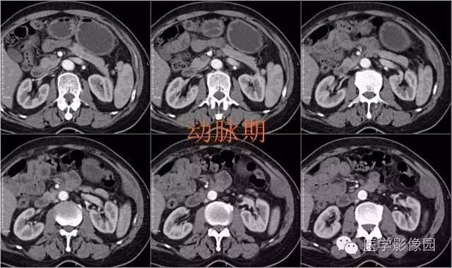 【病例】腹壁神经鞘瘤1例CT影像表现