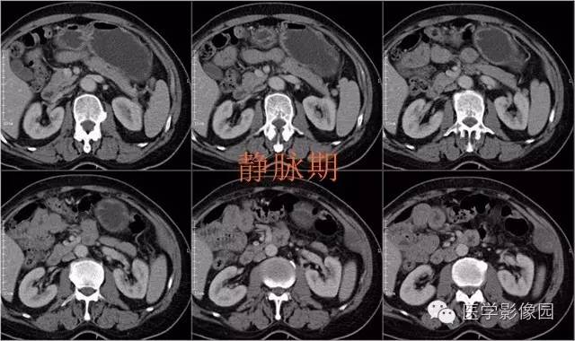 【病例】腹壁神经鞘瘤1例CT影像表现