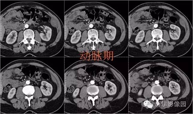 【病例】腹壁神经鞘瘤1例CT影像表现
