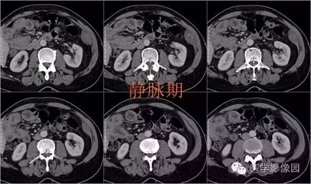【病例】腹壁神经鞘瘤1例CT影像表现