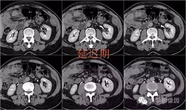 【病例】腹壁神经鞘瘤1例CT影像表现