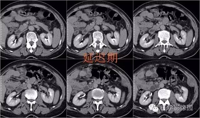 【病例】腹壁神经鞘瘤1例CT影像表现
