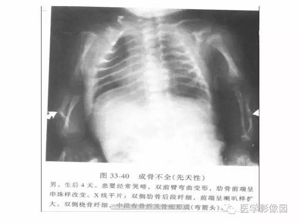 【PPT】骨与软骨发育异常