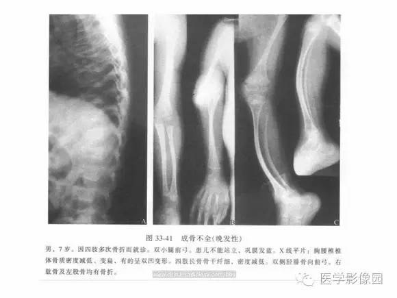 【PPT】骨与软骨发育异常