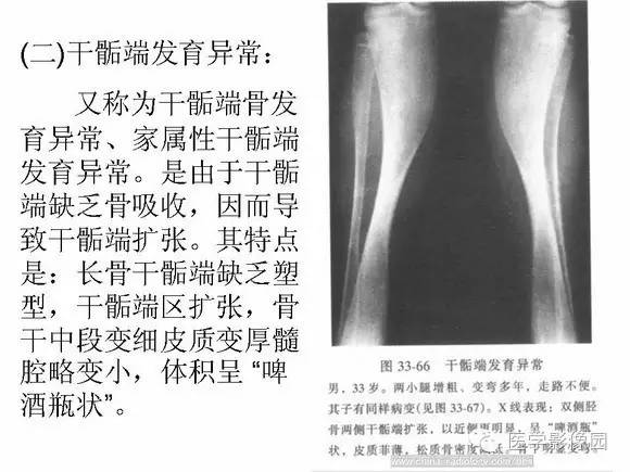 【PPT】骨与软骨发育异常