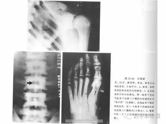 【PPT】骨与软骨发育异常